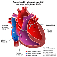 Haga clic en la imagen para ampliarla Anatomía de un corazón con una comunicación interauricular
