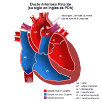 Haga clic en la imagen para ampliarla Anatomía de un corazón con conducto arterial persistente
