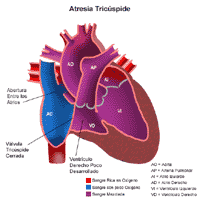Haga clic en la imagen para ampliarla Anatomía de un corazón con atresia tricúspide