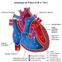 Haga clic en la imagen para ampliarla Anatomía de un corazón con tetralogía de Fallot