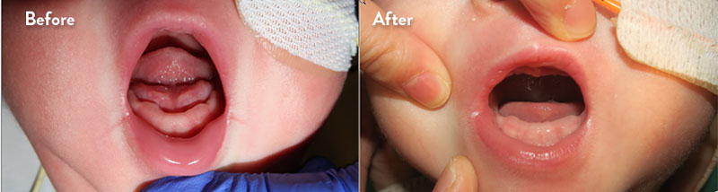 Before and after of infant with orthodontic airway plate treatment