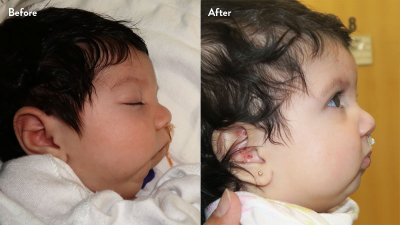 Before and after of infant with orthodontic airway plate treatment