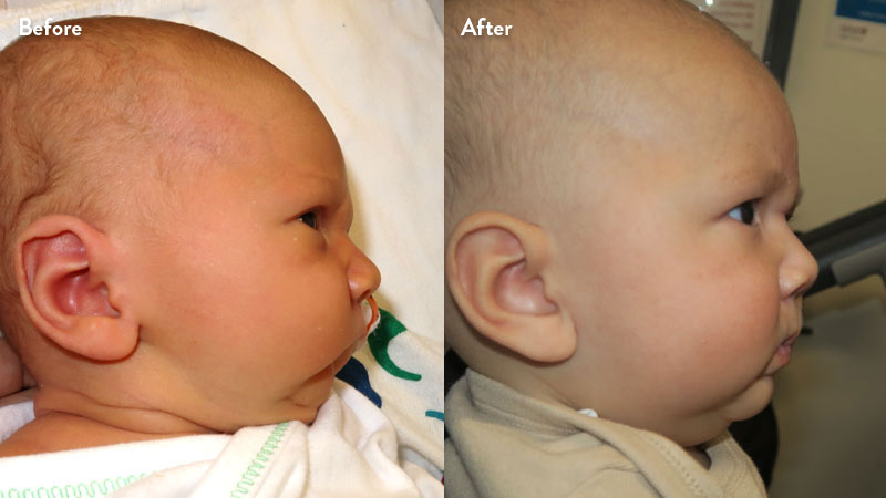 Before and after of infant with orthodontic airway plate treatment