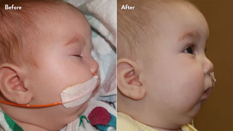 Before and after of infant with orthodontic airway plate treatment