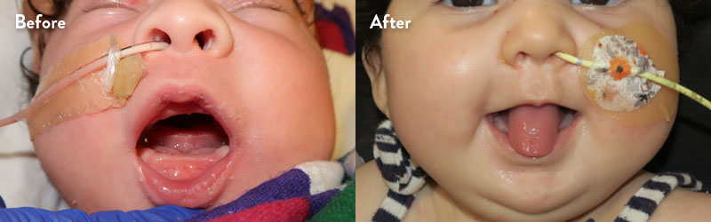Before and after of infant with orthodontic airway plate treatment