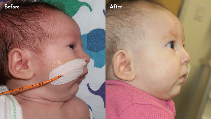 Before and after of infant with orthodontic airway plate treatment